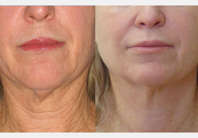 3Deep Skin Tightening