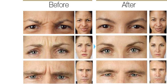 Botox after and before images