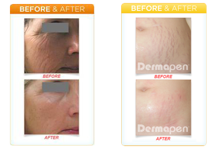 Botox after and before images