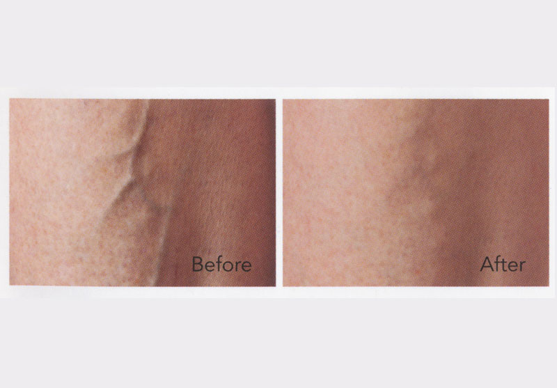Spider Vein Theraphy Sclerotherapy
